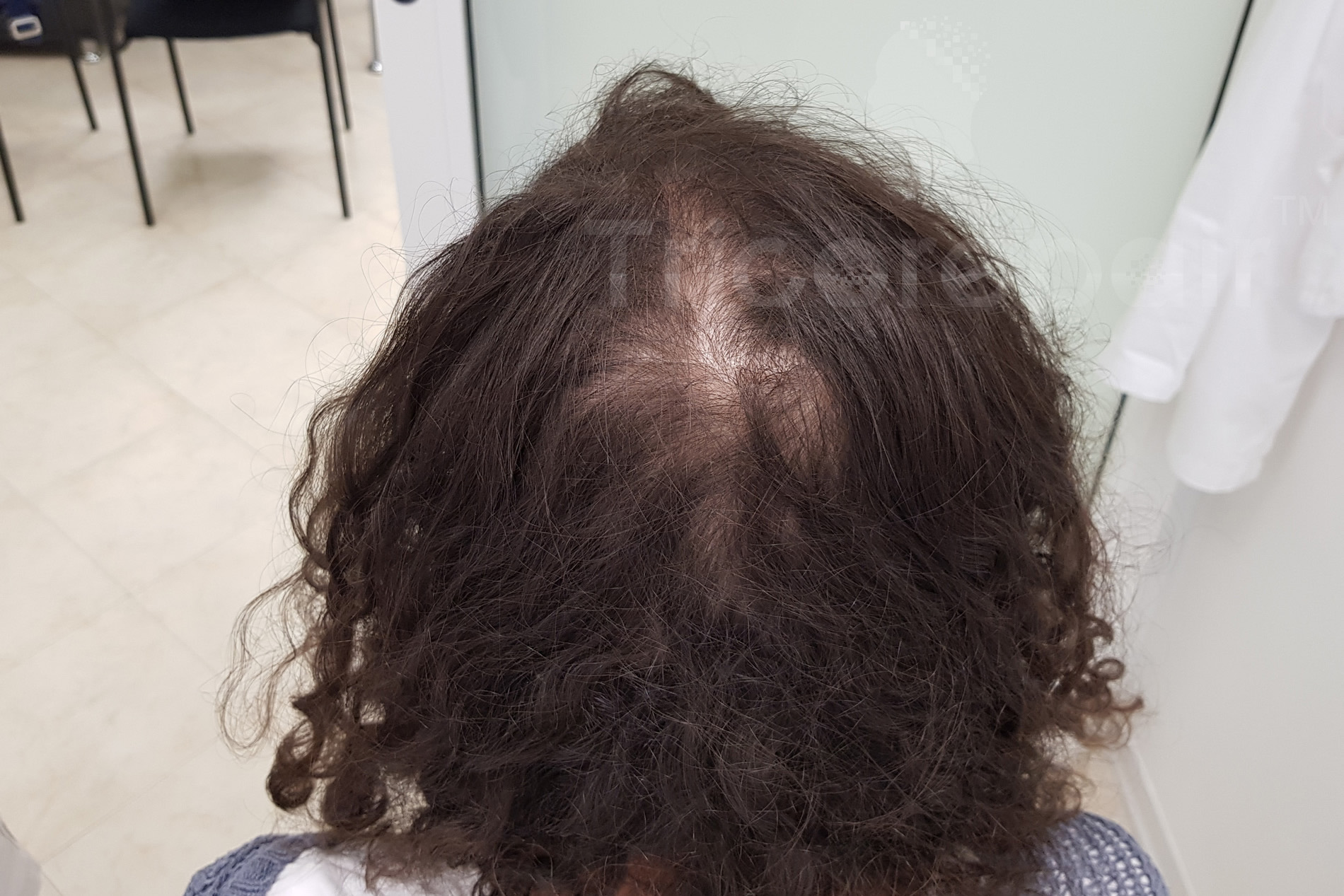 Alopecia femminile - Prima del trattamento