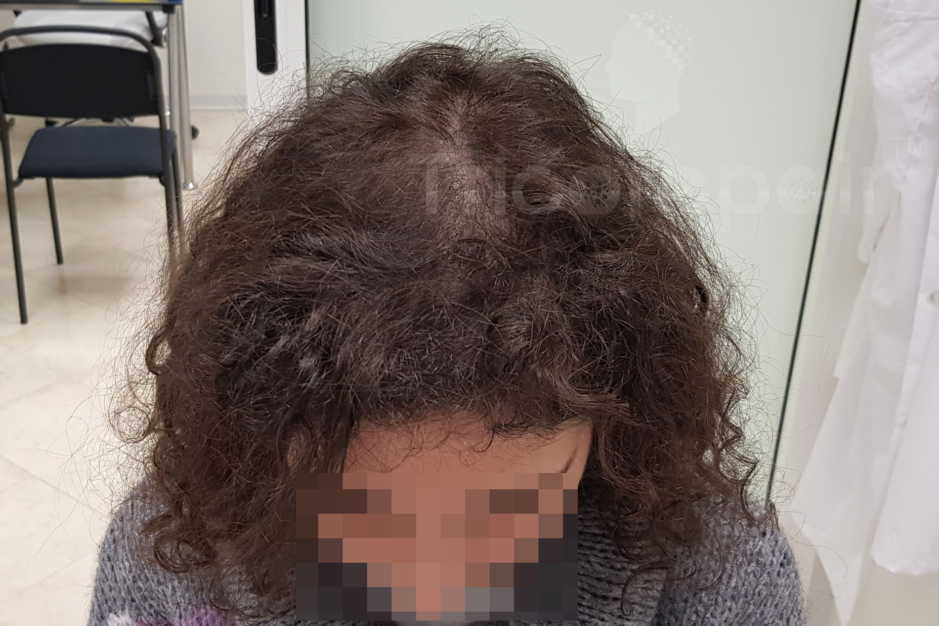 Alopecia femminile - Dopo il trattamento