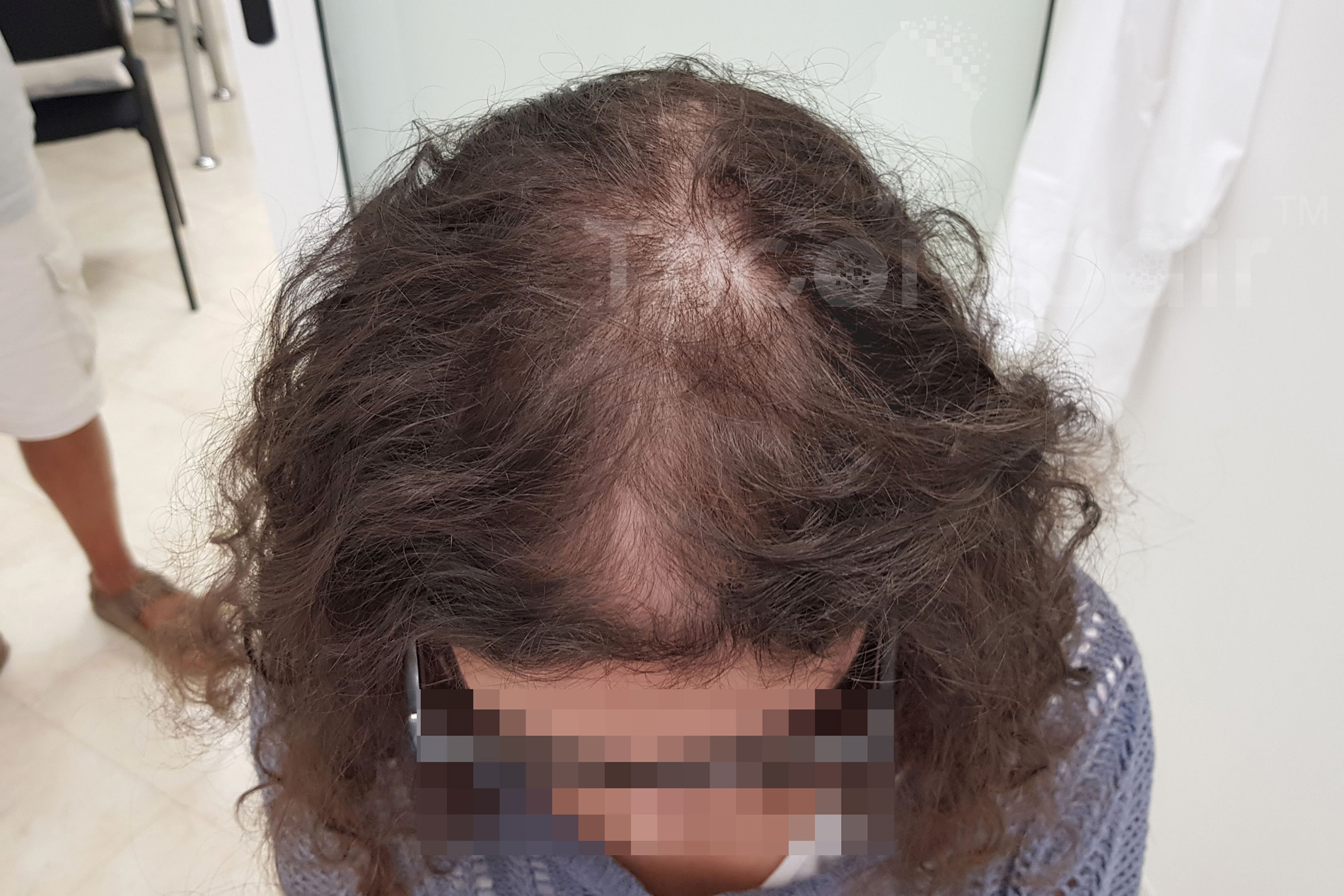 Alopecia femminile - Prima del trattamento
