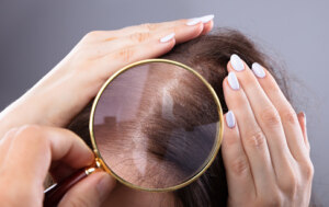 Alopecia Femminile 
