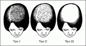 Scala di Ludwig - Alopecia Femminile